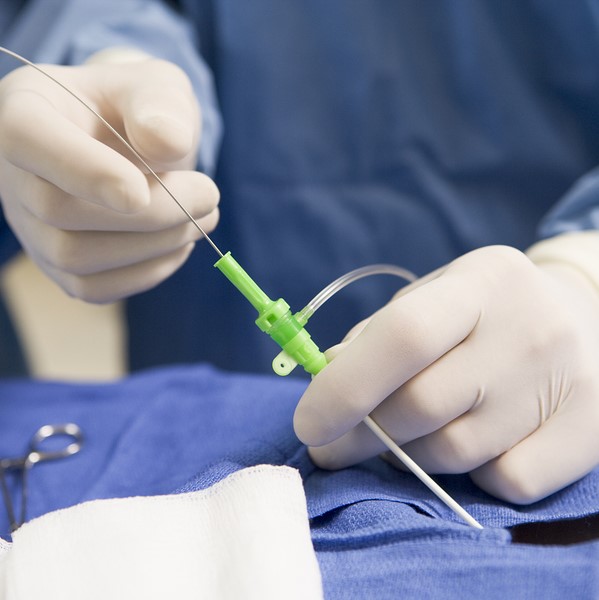 Endovenous Laser Ablation Endovenous Laser Ablation
