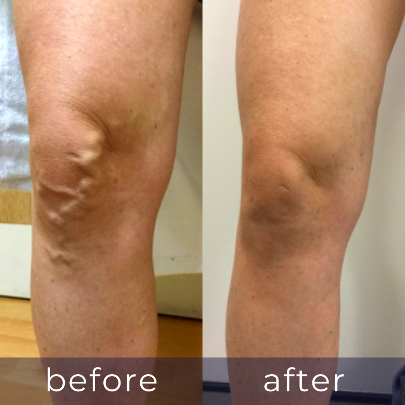 LVC treatments 1 LVC treatments 1