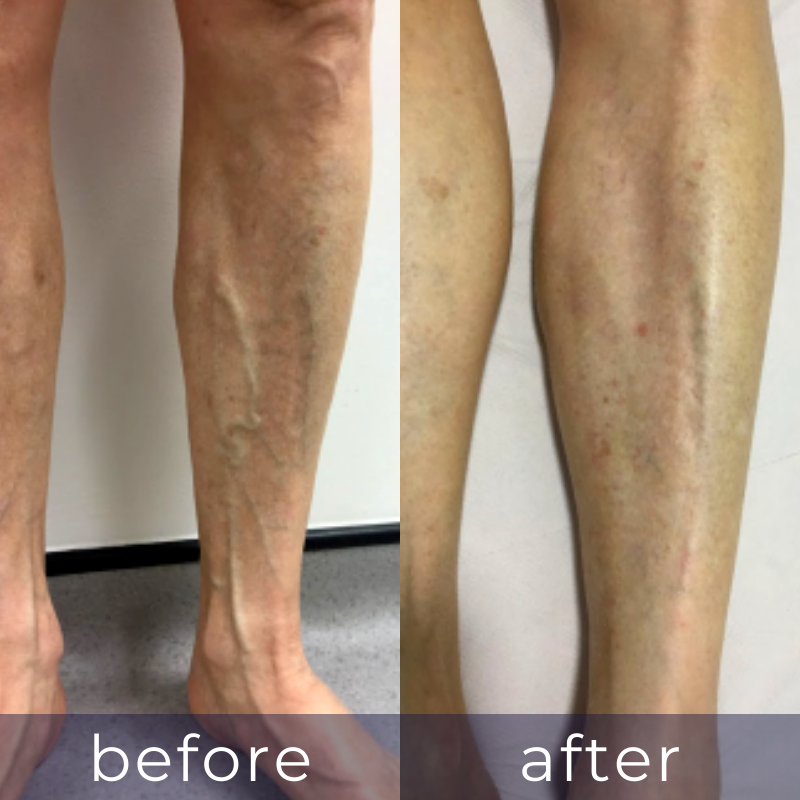LVC treatments LVC treatments