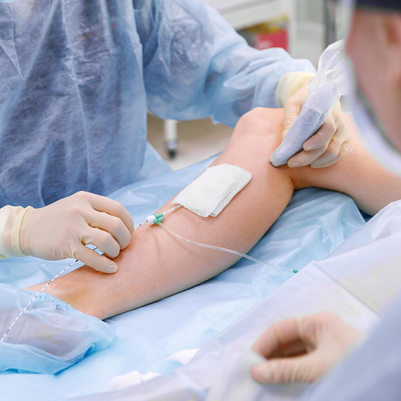 LVC treatments pelvic veins 1 LVC treatments pelvic veins 1