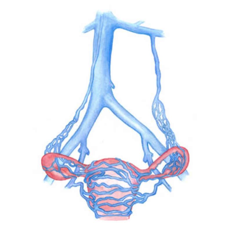 LVC treatments pelvic veins LVC treatments pelvic veins