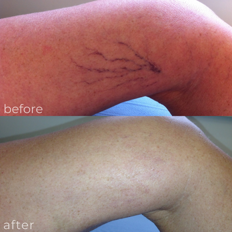 LVC treatments threadveins 1 LVC treatments threadveins 1
