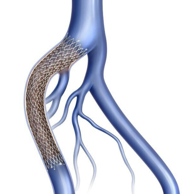 deep vein stent deep vein stent