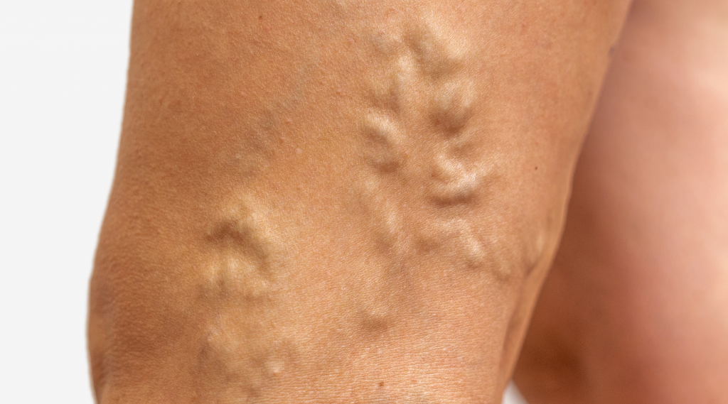 DVT deep vein thrombosis