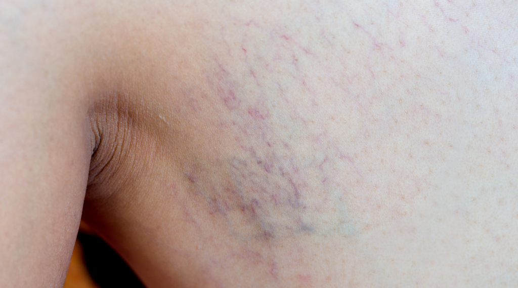 leg thread veins