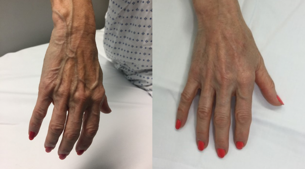 Hand Veins • London Vascular Clinic