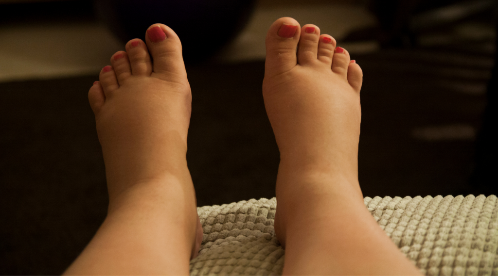 LVC vein problem swollen legs