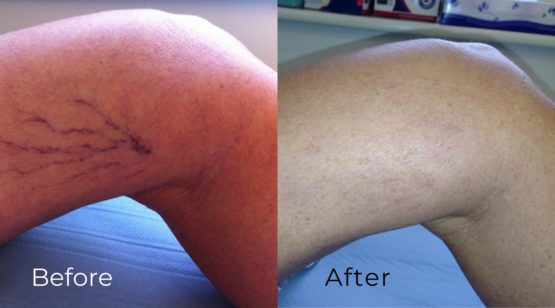 LVC_treatments_Microsclerotherapy