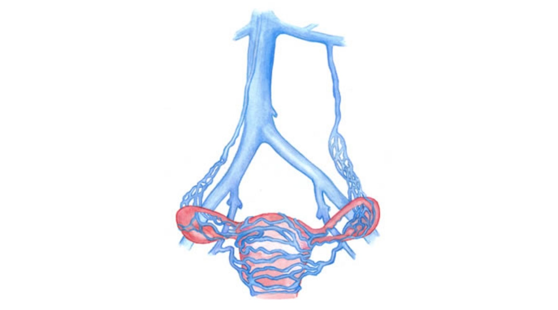 LVC treatments Pelvic vein embolization p3l1pvew9j48ufvo1s0jfvt8adiaoh8k64p8aemhow