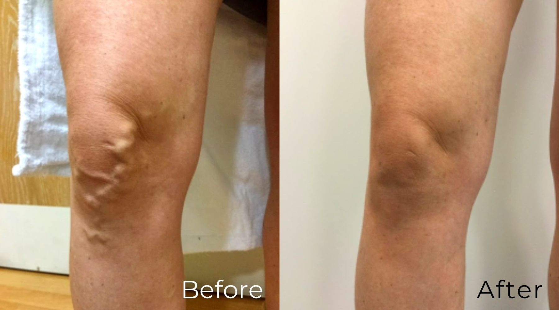 Varicose Veins  Nottingham Vascular Surgery