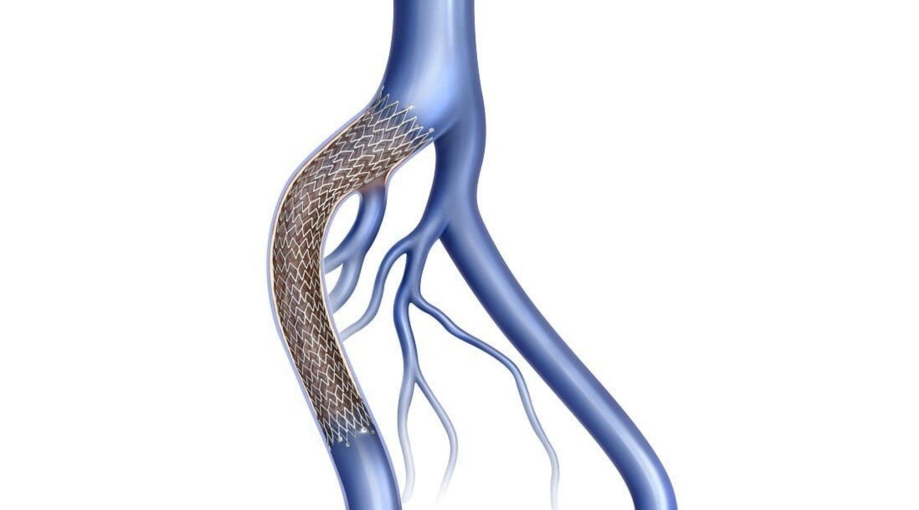 LVC treatments deep vein stenting p3l1iiceq91dwekp1lfqwqp8rpssdu095oqaydjifk