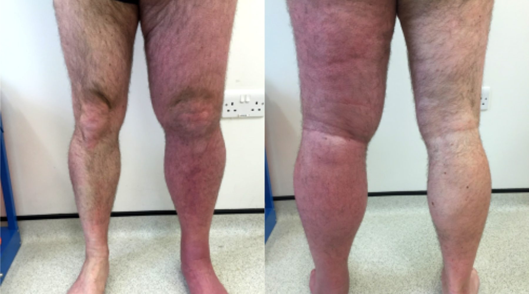 LVC treatments deep vein thrombosis removal