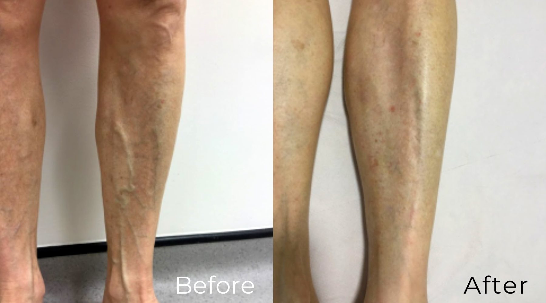 LVC_treatments_sclerotherapy